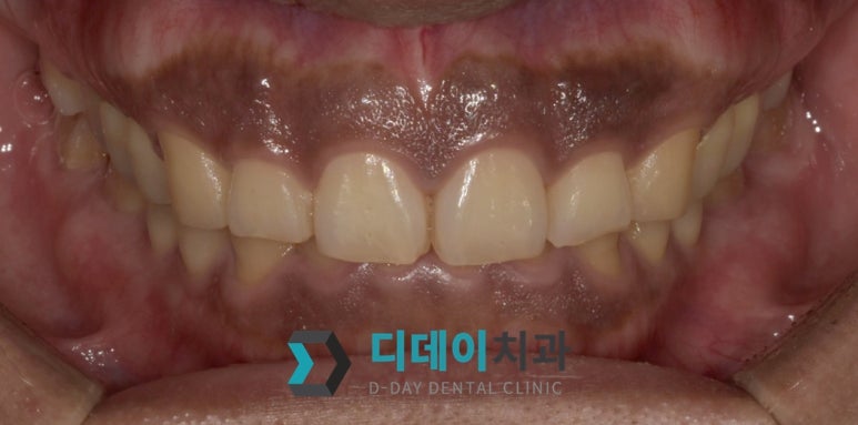 논현역 잇몸미백, 98%가 간과하는 시술 전 필수 체크리스트 관련 이미지 3