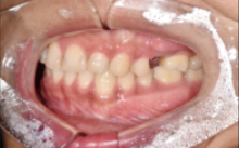 임플란트교체? 걱정되시는분들만 보세요. 관련 이미지 1