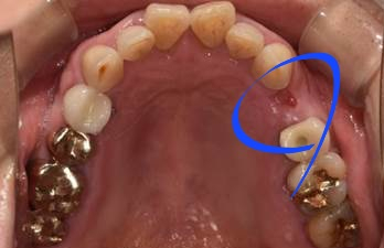 국산임플란트를 선택한 이유, 치료사례 공개합니다 관련 이미지 8
