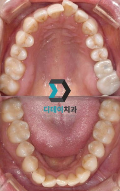 어금니가시려요, 원인별 해결법 의사가 알려드립니다 관련 이미지 8