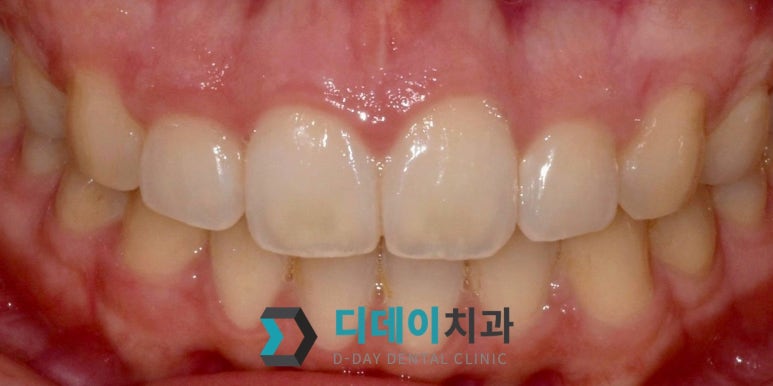 웃을 때 잇몸이 많이 보인다면, 몰라서 못하는 이것 관련 이미지 5