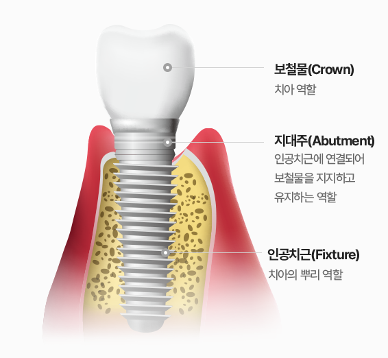 임플란트 후 음주, 왜, 얼마나 금주해야 할까요? 관련 이미지 3