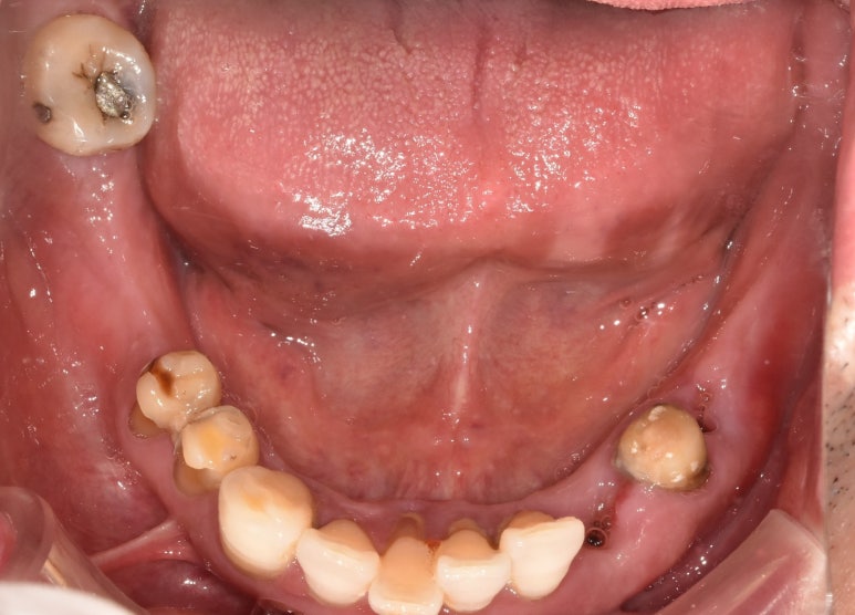 임플란트건강보험, 추가비용 없이 가능할까요? 관련 이미지 9
