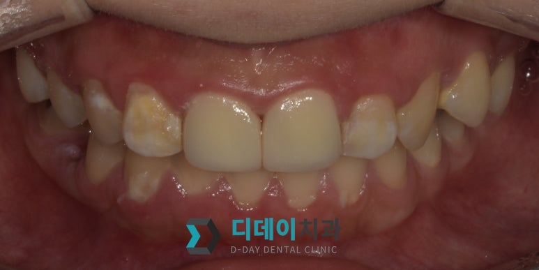 충치파절증상 초기에 발견하면 간단하게 치료됩니다 관련 이미지 5