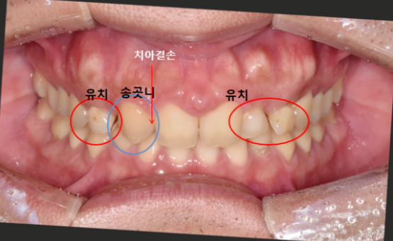 어금니발치후임플란트? 꼭 받아야 할지 궁금한 분은 보세요. 관련 이미지 1