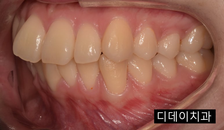 무삭제라미네이트 누구나 다 된다? 속지마세요. 관련 이미지 6