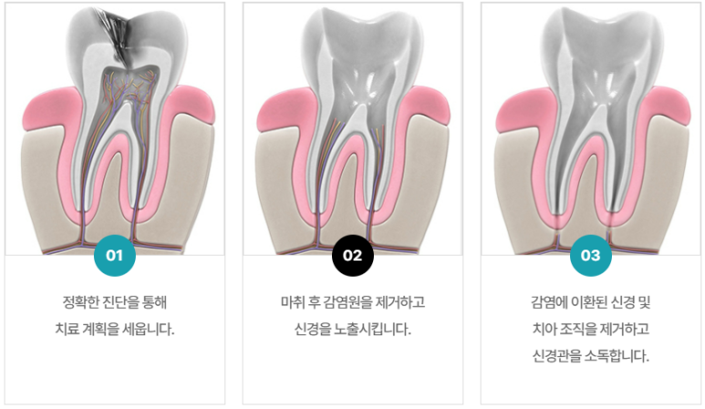 충치신경치료 그렇게 아픈가요? 신경치료통증 오해와 진실 관련 이미지 5