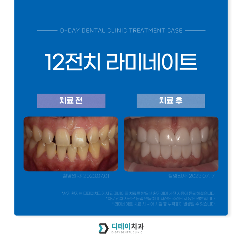 치아성형, 앞니 모양 획기적으로 바꾸는 방법이 있다? 관련 이미지 3