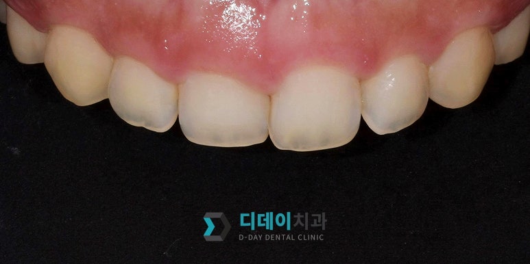 웃을 때 잇몸이 많이 보인다면, 몰라서 못하는 이것 관련 이미지 3