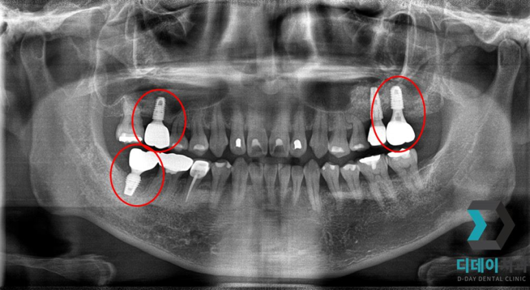 기저질환 환자, 임플란트 가능할까요? 관련 이미지 3