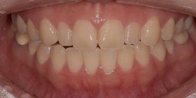 라미네이트 전후사진과 치료비용까지 숨김없이 알려드립니다. 관련 이미지 12