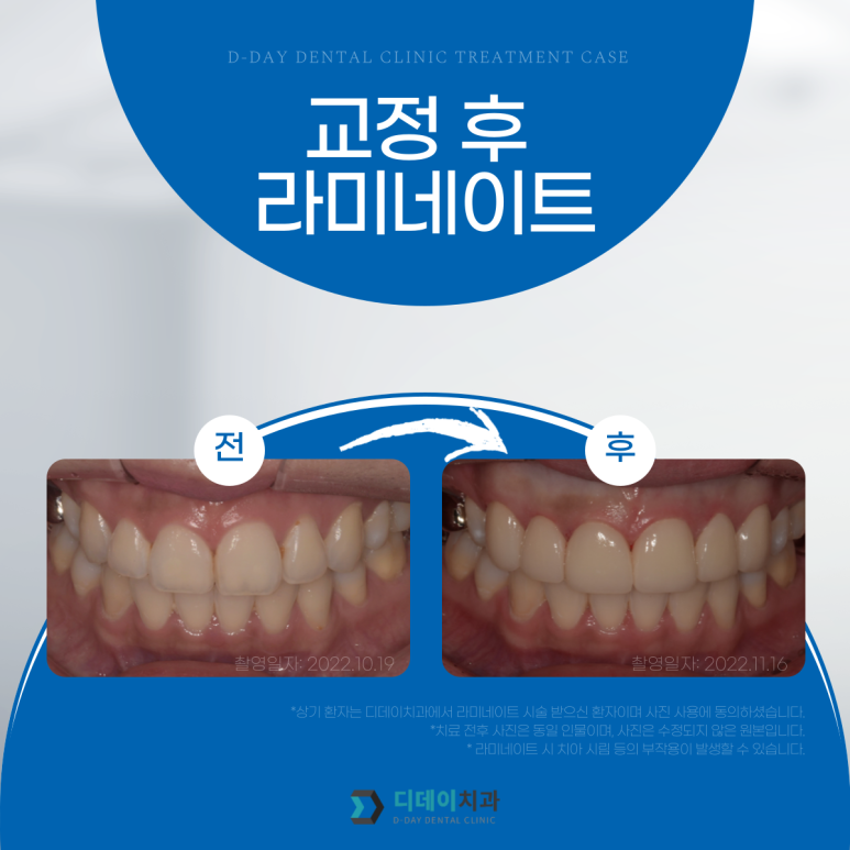 최소삭제라미네이트, 누구나 다 된다고 생각하면 오산입니다. 관련 이미지 6