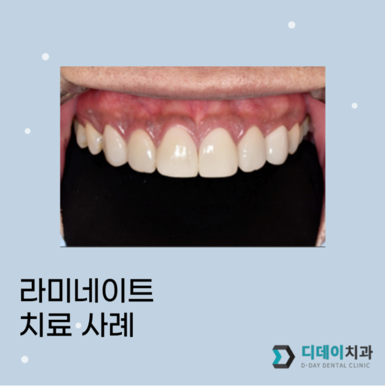 압구정라미네이트? "10년 전 보철물이 깨졌어요" 관련 이미지 1