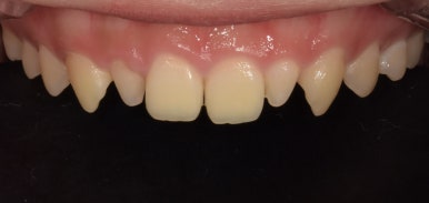 왜소치(작은치아)라미네이트? 치아 모양과 크기, 바꿀 수 있습니다. 관련 이미지 7