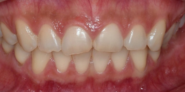 라미네이트 전후 비교, 주의사항, 비용까지 총정리 관련 이미지 5