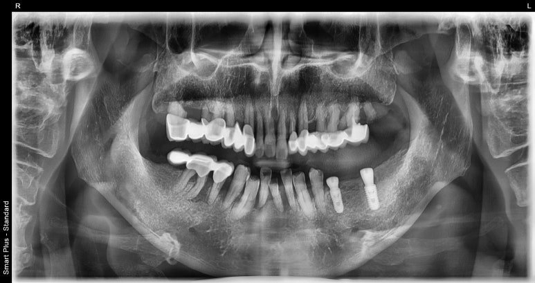보험임플란트, 임플란트브릿지로 치료한 사례 보여드립니다. 관련 이미지 5