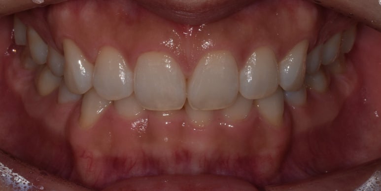 잇몸성형유지기간? 치과의사가 직접 알려드립니다. 관련 이미지 4