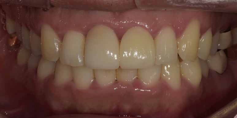 치간이개라미네이트, 벌어진 앞니 개선한 최신사례 관련 이미지 7