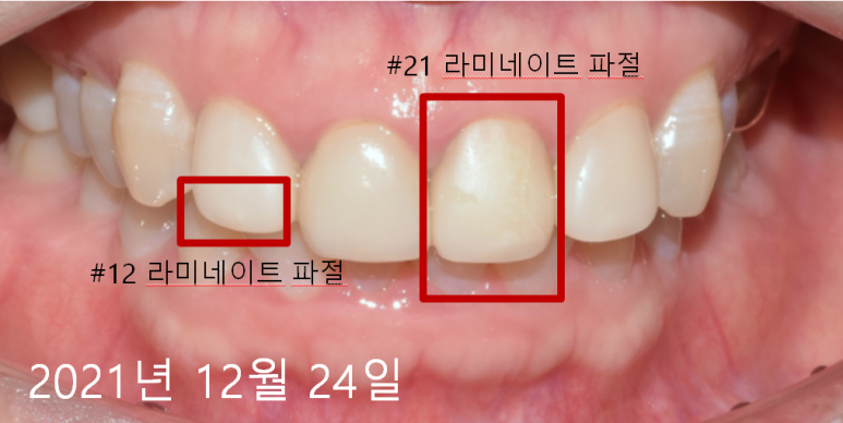 라미네이트떨어짐, 깨짐의 진짜 원인은 따로 있다? 관련 이미지 4