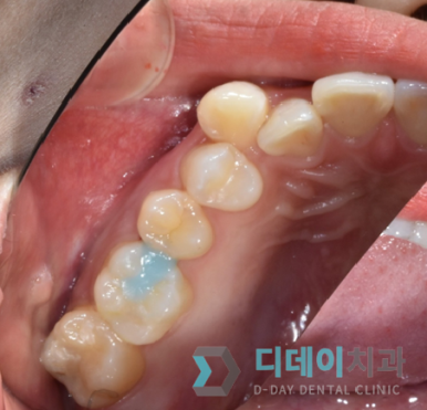 어금니충치치료비용, 병원마다 차이나는 진짜 이유 2가지 관련 이미지 9