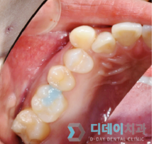 강남구청역치과? 방문 전 OOOO부터 확인하세요. 관련 이미지 7