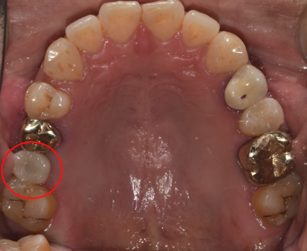 청담역치과? "뼈이식 없이" 임플란트 진행 사례 관련 이미지 7