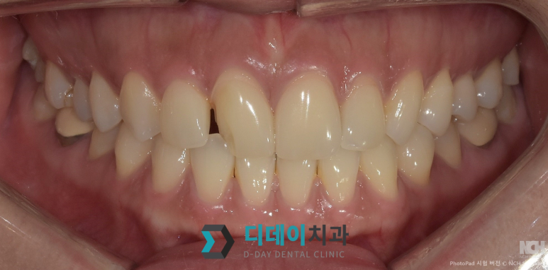 라미네이트 재시술,의사가 직접 설명합니다 관련 이미지 2