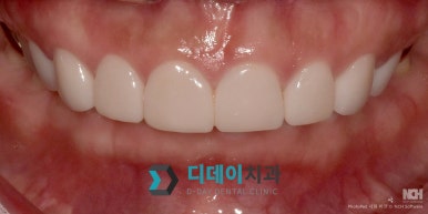 Protruding Mouth Laminate: Read This If Your Side Profile Has Been Especially on Your Mind image 5
