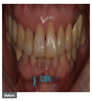 모델 라미네이트? 치과 어디서 받는게 좋을까요? 관련 이미지 3