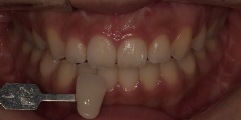 치과치아미백, 전후사진과 치료비용이 궁금하다면? 관련 이미지 5