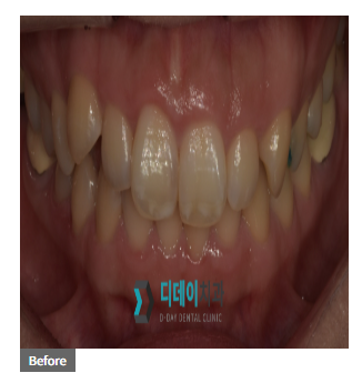 웨딩 전 라미네이트, 하시고도 후회하고 싶으시면? 관련 이미지 2