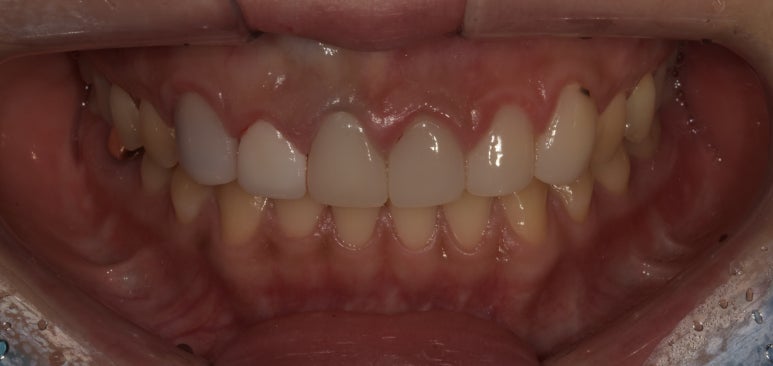 라미네이트떨어짐, 탈락 시 재부착 가능할까요? 관련 이미지 6