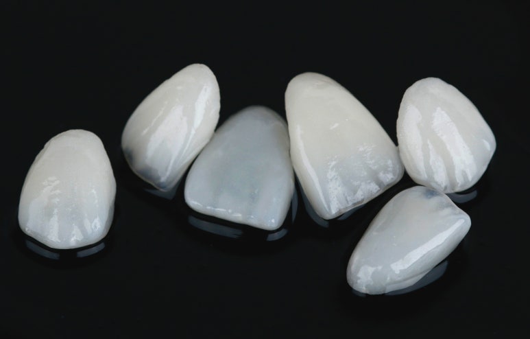 최소삭제라미네이트, 비용부터 치과 고르는 방법 관련 이미지 10