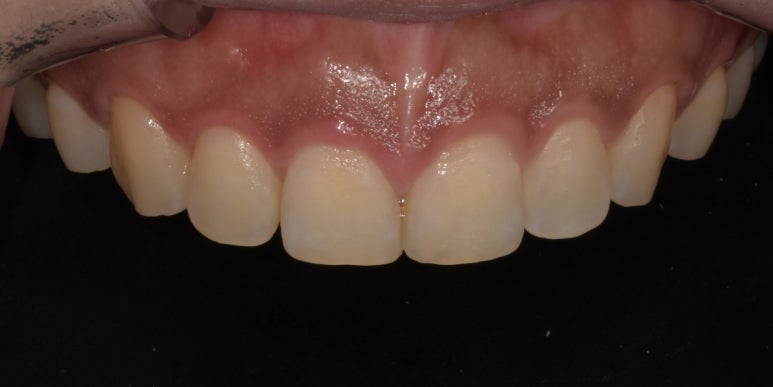 치아성형비용, 비싼 것만은 아닙니다. 관련 이미지 3