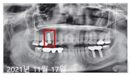 국산임플란트가격? 이 글로 종결합니다. 관련 이미지 4