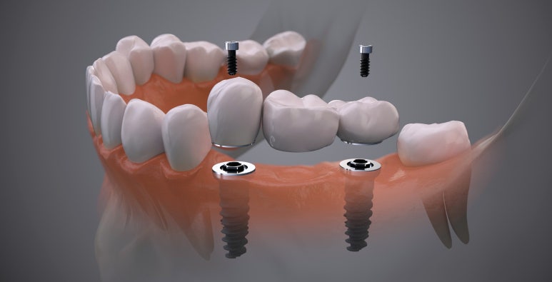 임플란트잘하는병원? 치과의사가 말하는 3가지 특징 관련 이미지 9