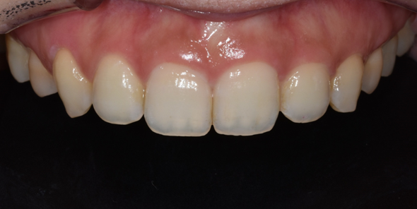 치은절제술/성형술? 잇몸이 치아를 덮고 있어 고민인 분만 관련 이미지 7