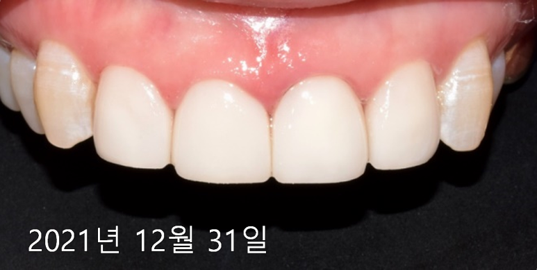 라미네이트 주의사항? 잘못 시술되면 이런 부작용 옵니다... 관련 이미지 7