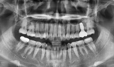 젊은나이임플란트? 젊을수록 더 빨리 심어야합니다. 관련 이미지 6