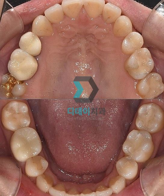 세라믹인레이장점과 단점 솔직하게 말씀드립니다 관련 이미지 3