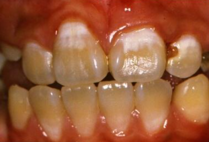 충치초기과정, 육안으로 안 보이는 이유 2가지 관련 이미지 3