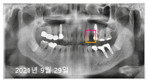 임플란트가격싼곳? 비용보다 중요하게 봐야하는 "이것" 관련 이미지 5