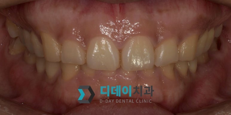 논현역 잇몸미백, 98%가 간과하는 시술 전 필수 체크리스트 관련 이미지 4