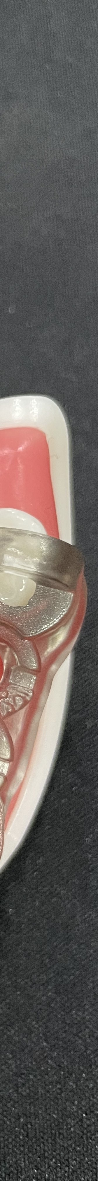 강남역 치과 임플란트 수면마취?해야만 하는 경우 관련 이미지 14