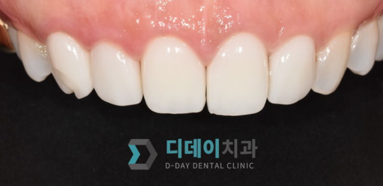 라미네이트 재시술,의사가 직접 설명합니다 관련 이미지 7