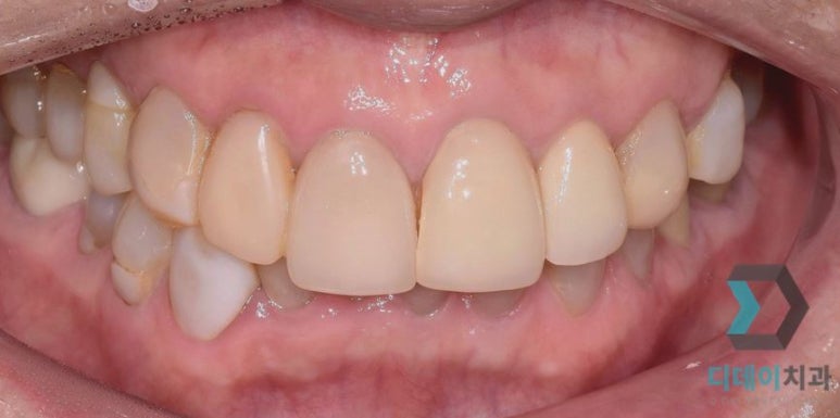 라미네이트교체, 재시술은 더 신중해야 하는 이유? 관련 이미지 3