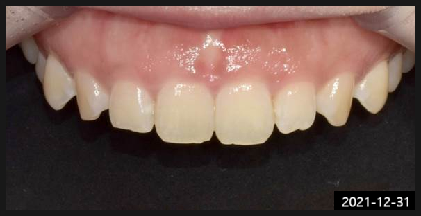 언주역치과, 의사 실력 모르겠다면? OO부터... 관련 이미지 5