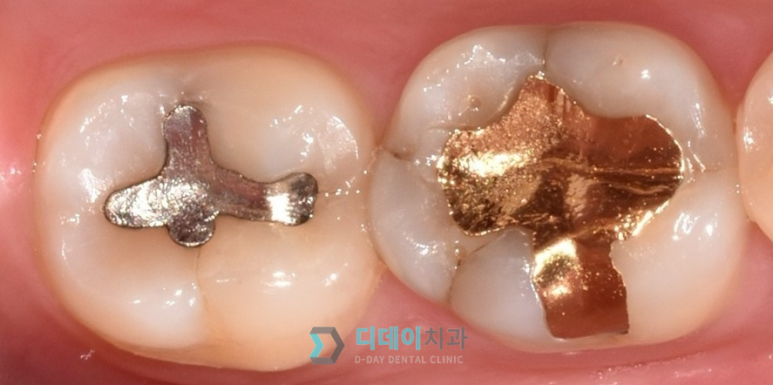 강남충치치료? 티 안나는 "인레이" 치료 사례 관련 이미지 2