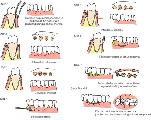 근단변위판막술, 이 글 하나로 궁금증 해결하세요 관련 이미지 3