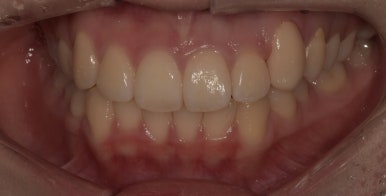 덧니교정만 된다? 라미네이트로도 덧니 치료 가능합니다. 관련 이미지 8